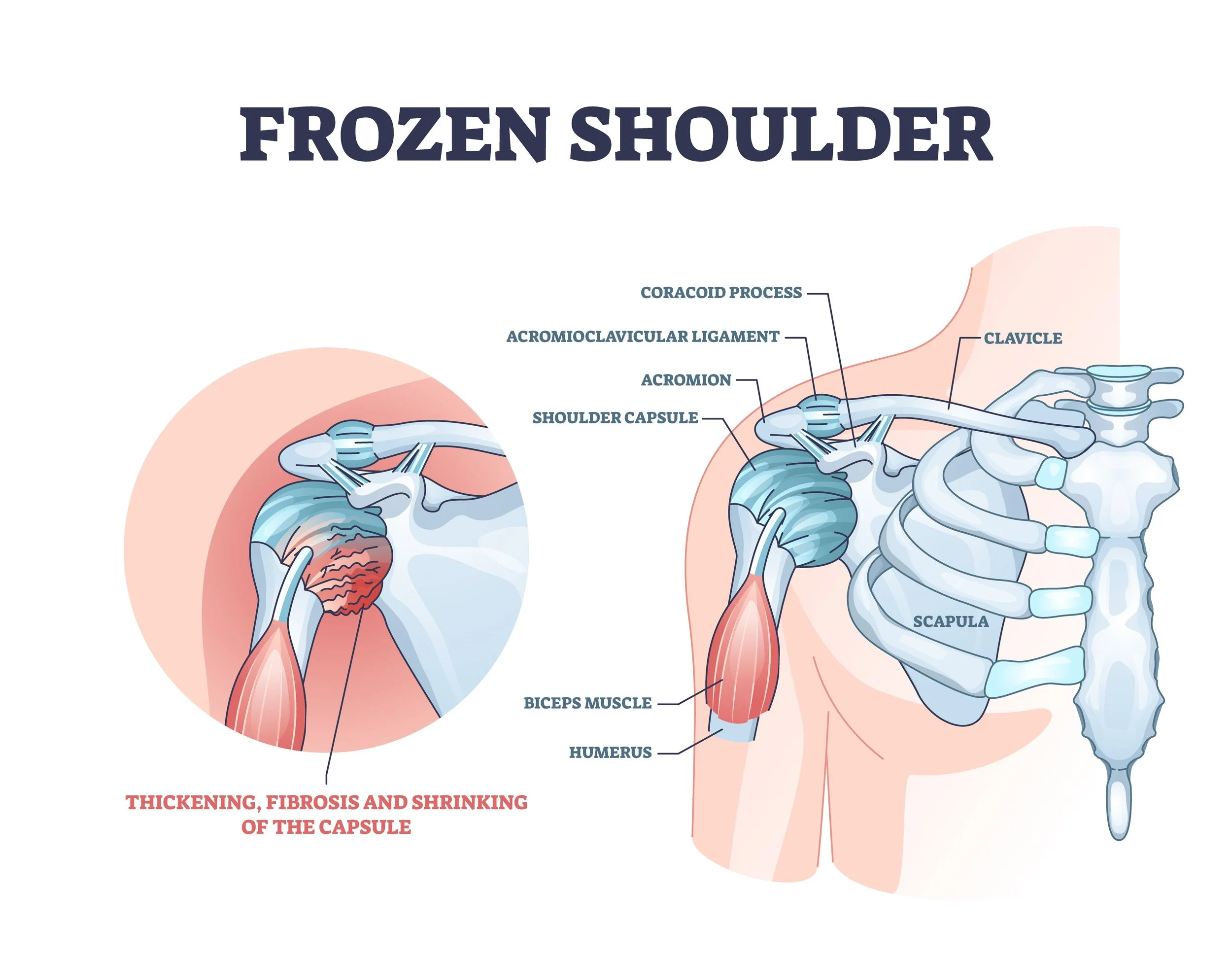 Combining Acupuncture and Physical Therapy for Frozen Shoulder